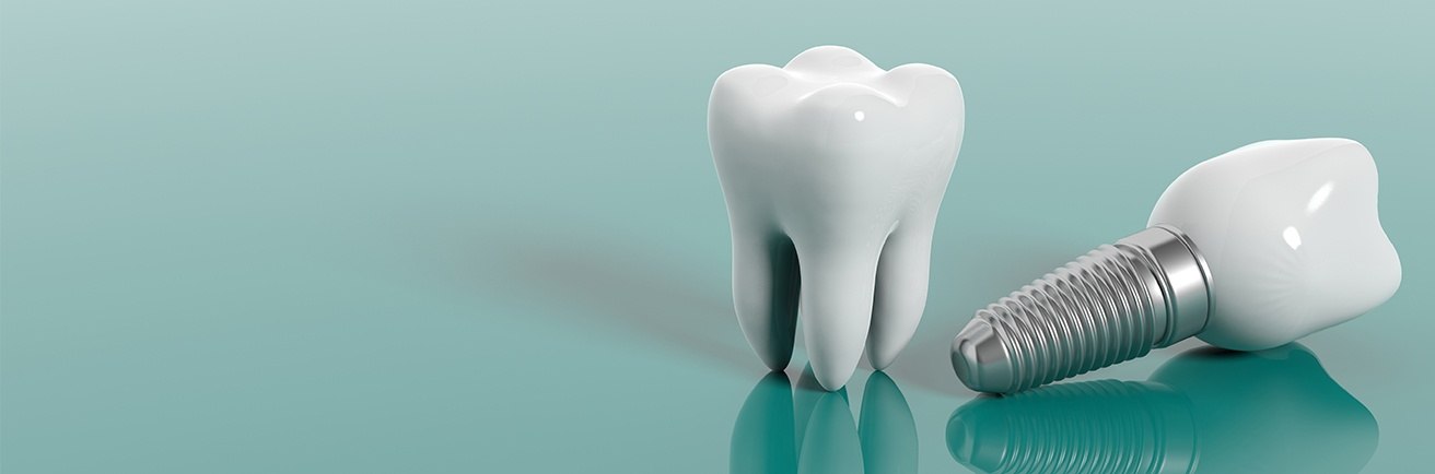 Animation of tooth and dental implant