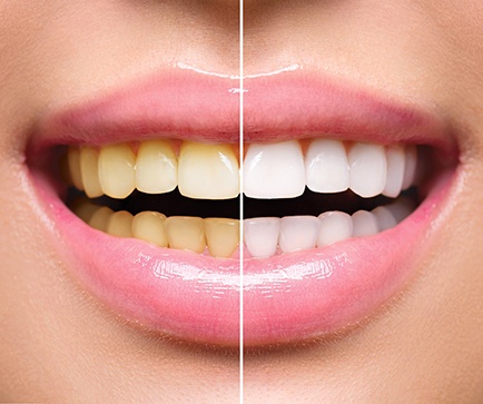 Close up of teeth before and after whitening